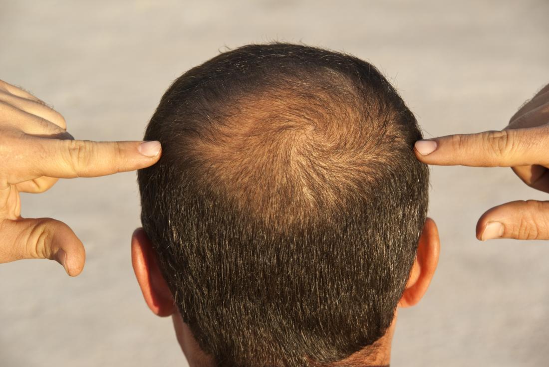 العمر المناسب لزراعة الشعر